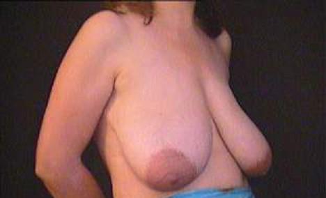 Meiosi kai anorthosi stithous profil prin 1